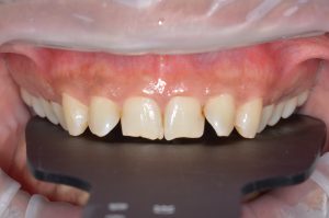 Read more about the article How Long Does Invisalign Take? Typical Timelines by Case Type