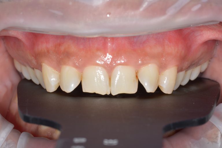 Read more about the article How Long Does Invisalign Take? Typical Timelines by Case Type