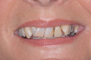 Read more about the article Invisalign vs Braces: Which Is Better for Adults? (Pros, Cons, Results)