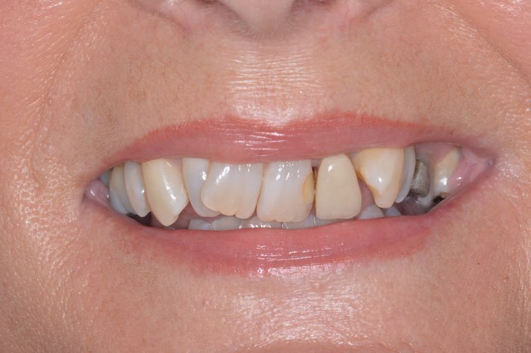 Read more about the article Invisalign vs Braces: Which Is Better for Adults? (Pros, Cons, Results)