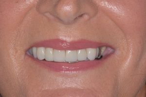 Read more about the article What Can Invisalign Fix? Overbite, Underbite, Crowding, Gaps (Realistic Outcomes)