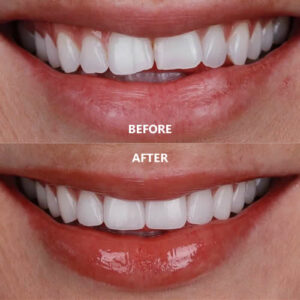 Read more about the article Invisalign Before and After: What Results Are Realistic (and How to Get the Best Outcome)