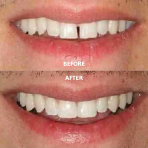 Read more about the article Invisalign Attachments, IPR, Elastics: Explained in Plain English