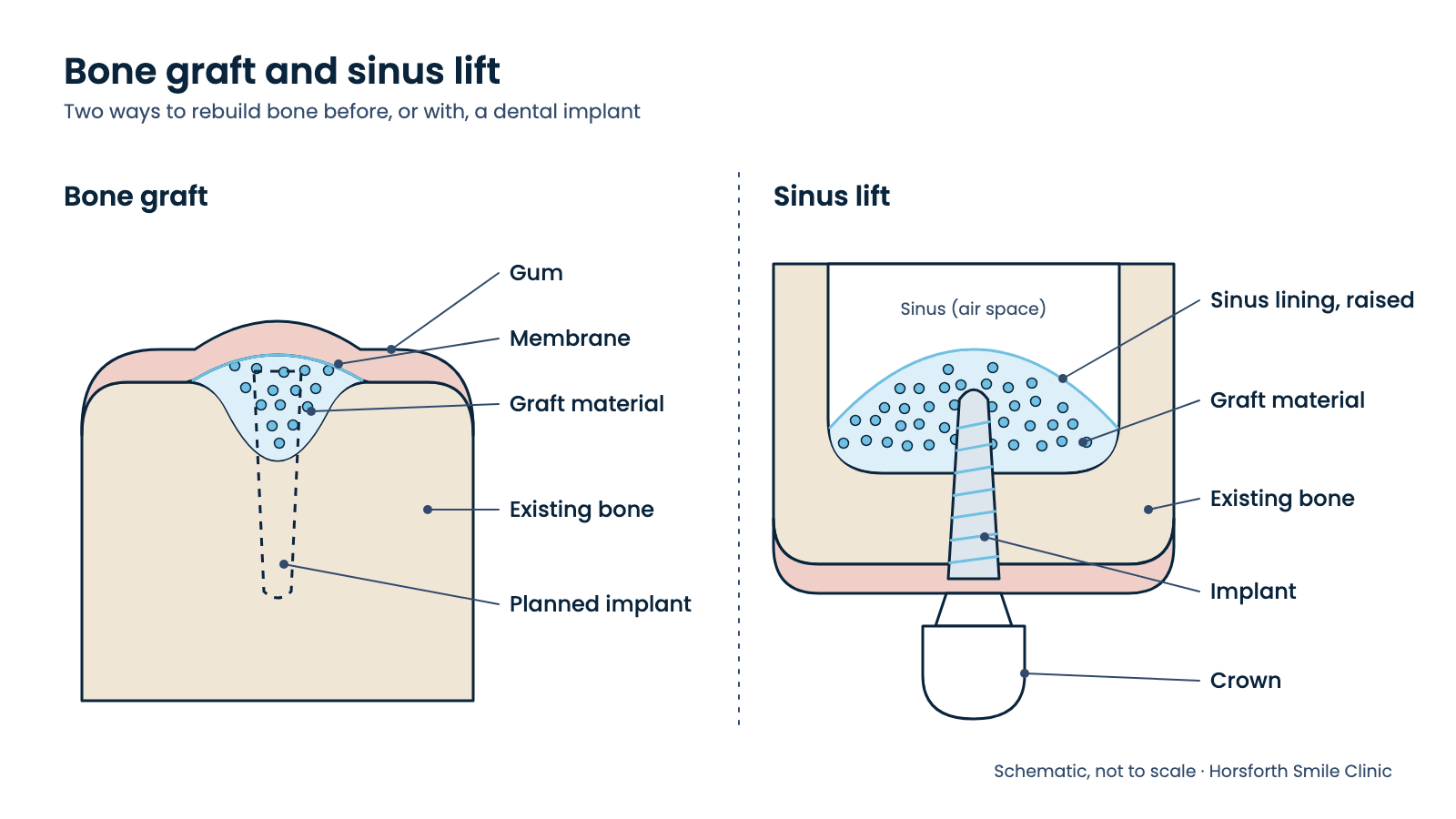 You are currently viewing Bone Grafts and Sinus Lifts for Dental Implants: What to Expect
